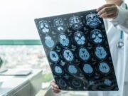 ASTUCE Spain impulsa la protecció oficial de l’oligodendroglioma