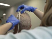 El 12 de Octubre participa en un assaig en fase 3 amb TTFields i immunoteràpia per millorar el glioblastoma